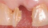 cracked and damaged tooth