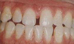 Teeth with gaps before veneers in Lincoln, NE