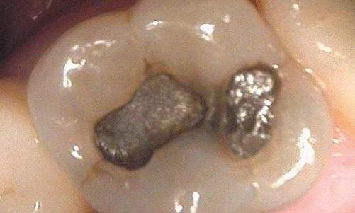 White-Dental-Fillings-Used-to-Replace-Old-Metal-Fillings-Before-Image