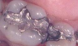 White-Dental-Fillings-Before-Image