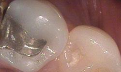 Molar with metal dental filling at dentist in Lincoln 68506