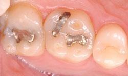two metal dental fillings 