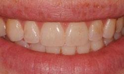 Professional-Teeth-Whitening-Before-Image