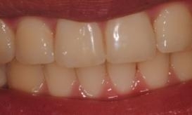 In-Office-Professional-Whitening-Before-Image